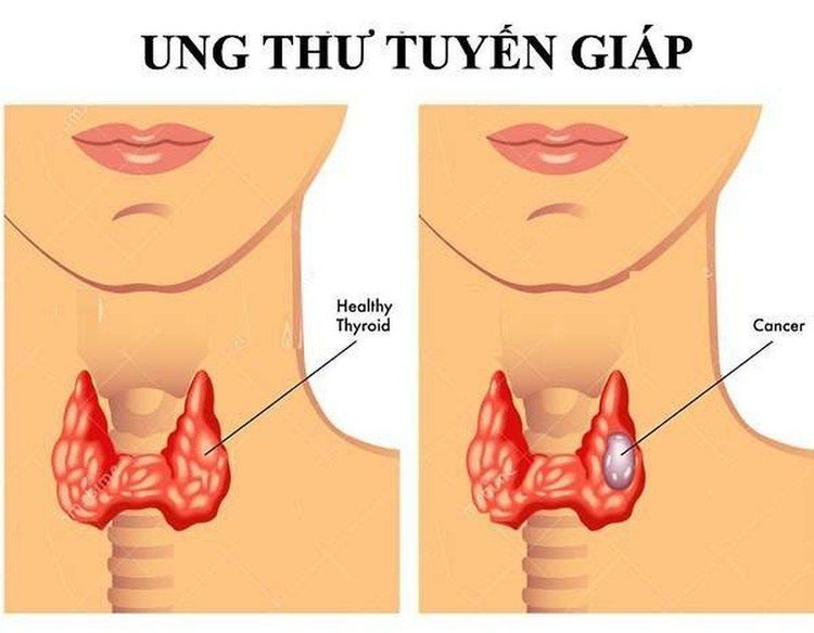 
Ung thư tuyến giáp có rất nhiều thể
