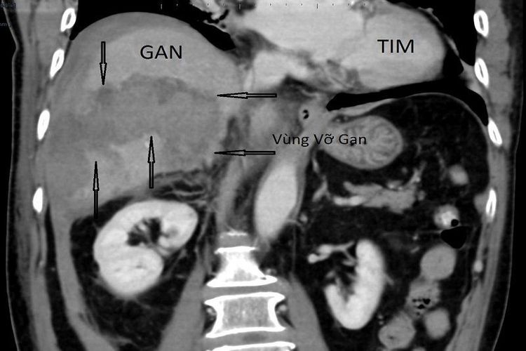 
Hình ảnh chụp CT vùng vỡ gan
