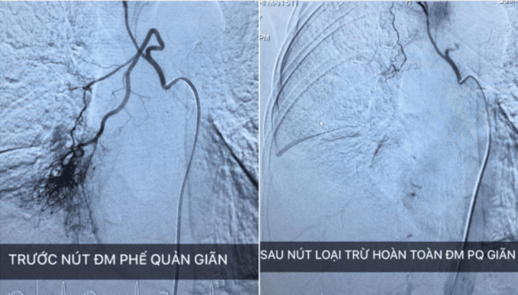 
Nút động mạch phế quản là phương pháp điều trị tiên tiến, ít xâm lấn
