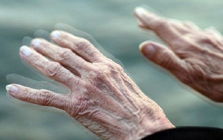 
Run chân tay là một trong những dấu hiệu của bệnh Parkinson
