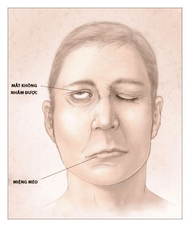 
Tình trạng liệt nửa mặt có thể xảy ra với mọi lứa tuổi
