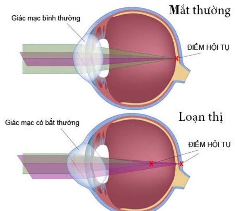 
Loạn thị gây ảnh hưởng đến tầm nhìn của người bệnh
