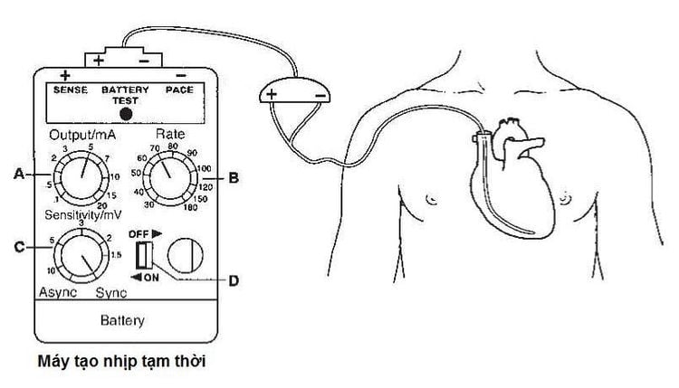 
Đặt máy tạo nhịp tạm thời qua đường tĩnh mạch dưới đòn phải (Nguồn hình: https://www.dicardiology.com)
