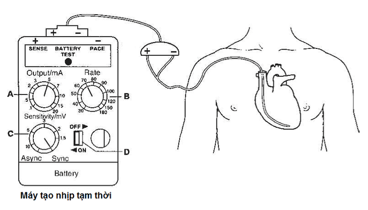 
Đặt máy tạo nhịp tạm thời qua đường tĩnh mạch dưới đòn phải (Nguồn hình: https://www.dicardiology.com)
