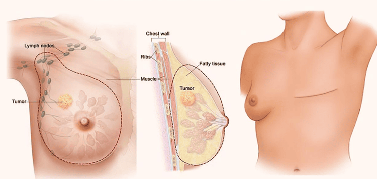 
Phẫu thuật cắt bỏ vú nhằm điều trị bệnh ung thư vú
