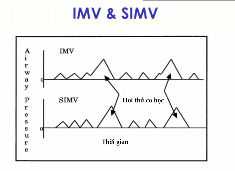 
Hơi thở cơ học trên IMV/SIMV
