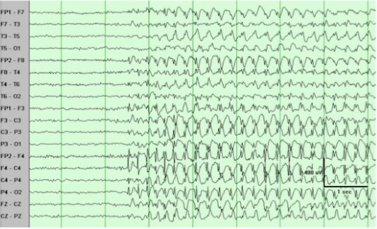 
Điện não đồ (EEG) động kinh xuất hiện các hoạt động kịch phát gai nhọn sóng
