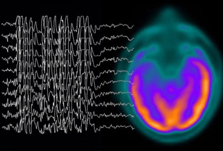 
Điện não đồ (EEG) giúp các bác sĩ chẩn đoán tình trạng động kinh ở người bệnh
