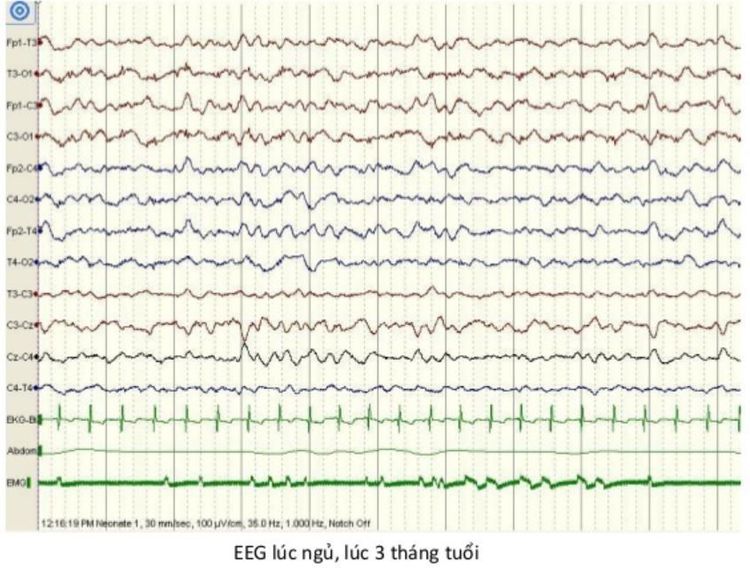 
Hình ảnh kết quả EEG lúc ngủ của trẻ 3 tháng tuổi
