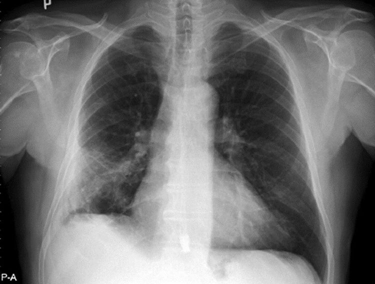 
Những cytokine có thể gây ra hội chứng suy hô hấp cấp tính và đe dọa đến tính mạng người bệnh
