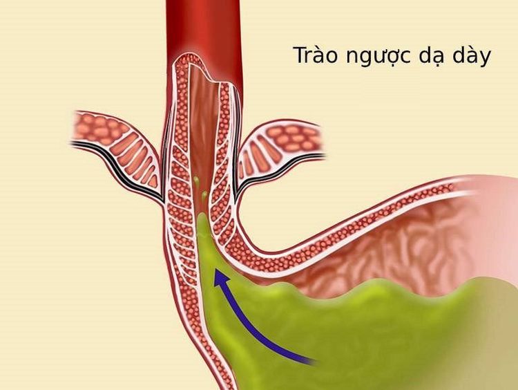 Trào ngược dịch dạ dày có thể xảy ra khi thực hiện kỹ thuật gây mê nội khí quản