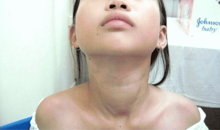 
Suy giáp do bướu cổ ở trẻ có thể gây giảm thyroglobulin
