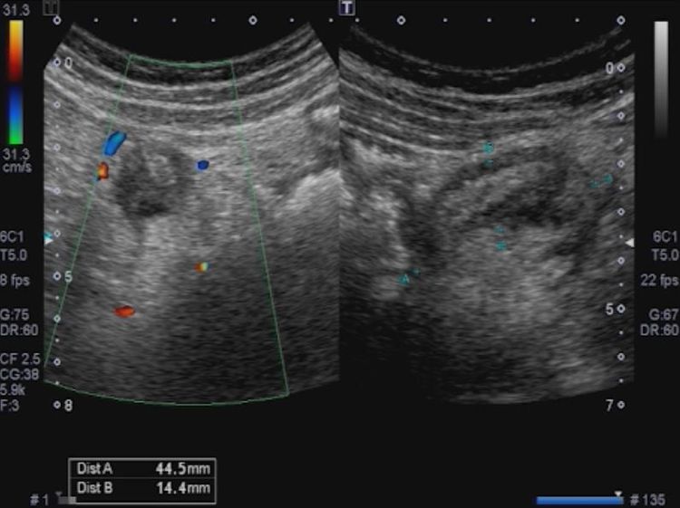 Hình ảnh viêm ruột thừa cấp trên siêu âm
