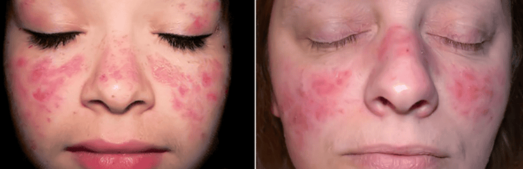 
Lupus Vulgaris là loại lao da thường gặp nhất
