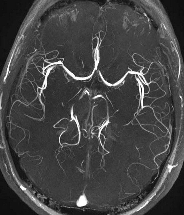 
Chụp MRI não sẽ cho kết quả rõ ràng hợp chụp cắt lớp vi tính
