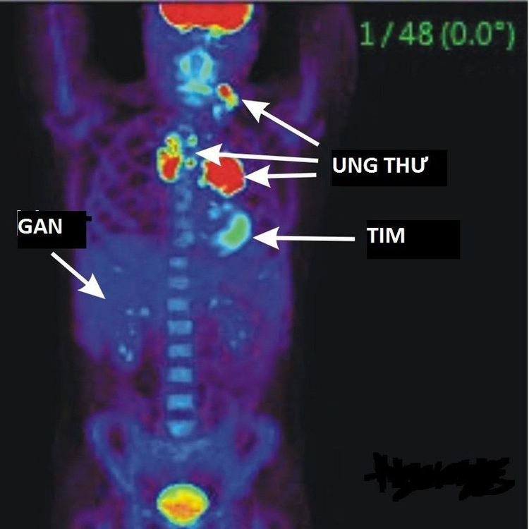 
PET/CT giúp ghi hình tưới máu cơ tim và đánh giá sự sống còn của cơ tim sau can thiệp và sau điều trị
