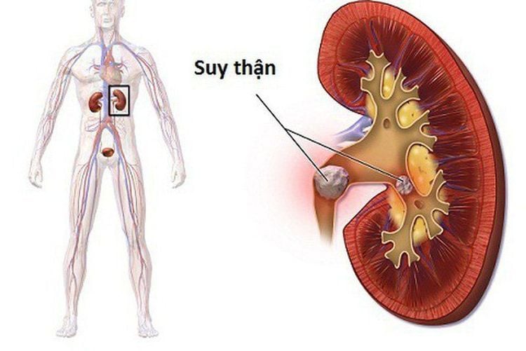 Bệnh nhân suy thận cần xem xét kĩ càng khi chụp CLVT động mạch chủ - chậu có tiêm thuốc đối quang i ốt