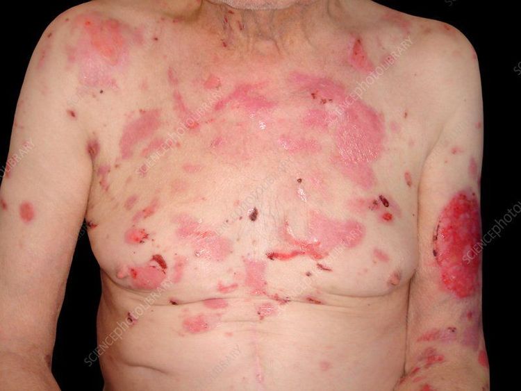 
Pemphigus thông thường
