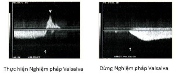 
Hình ảnh kết quả siêu âm bằng nghiệm pháp Valsalva
