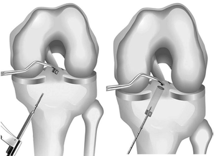 
Tái tạo dây chằng chéo trước có thể được thực hiện theo cách mổ hở mở khớp truyền thống hoặc mổ nội soi
