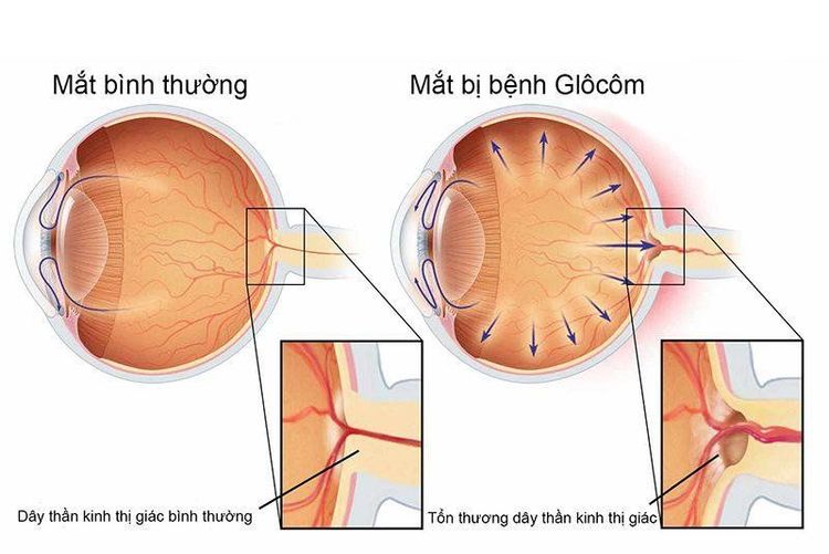 
Tăng nhãn áp là biến chứng mạch máu nhỏ do đái tháo đường
