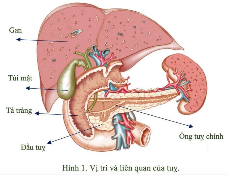 
Hầu hết viêm tụy mạn biểu hiện bởi sỏi ống tụy
