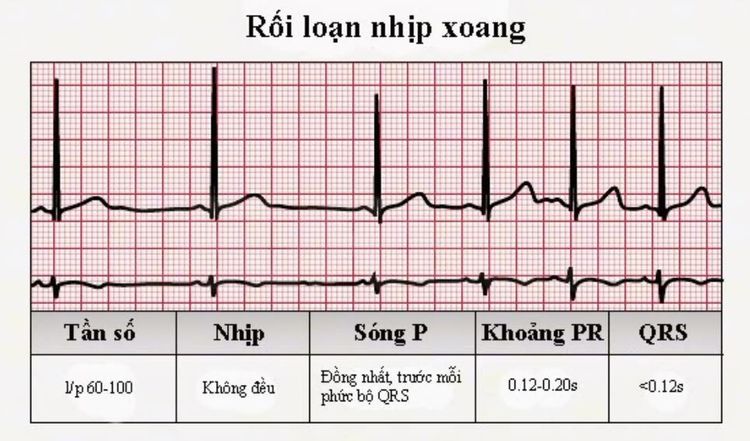 
Hình ảnh ECG loạn nhịp xoang
