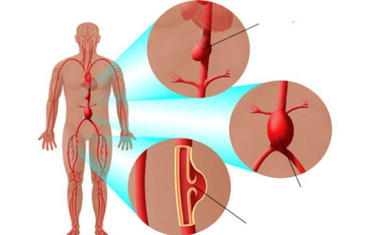 
Bệnh nhân mắc giả phình mạch được chỉ định chụp số hóa xóa nền chi
