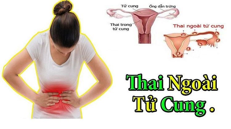 
Sử dụng phương pháp IVF có nguy cơ mang thai ngoài tử cung
