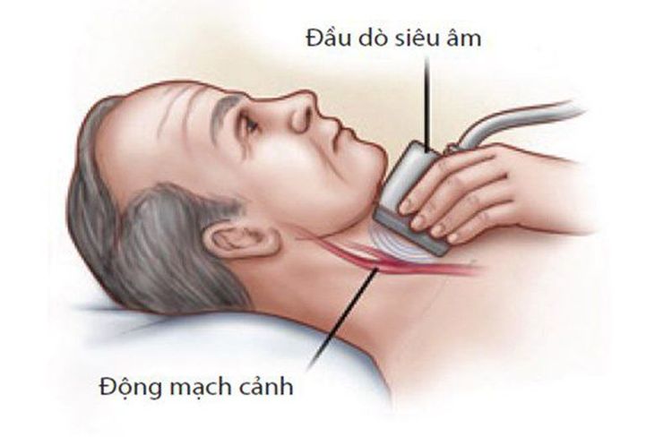 
Siêu âm động mạch cảnh là một kỹ thuật không gây đau đớn và rất an toàn cho người bệnh
