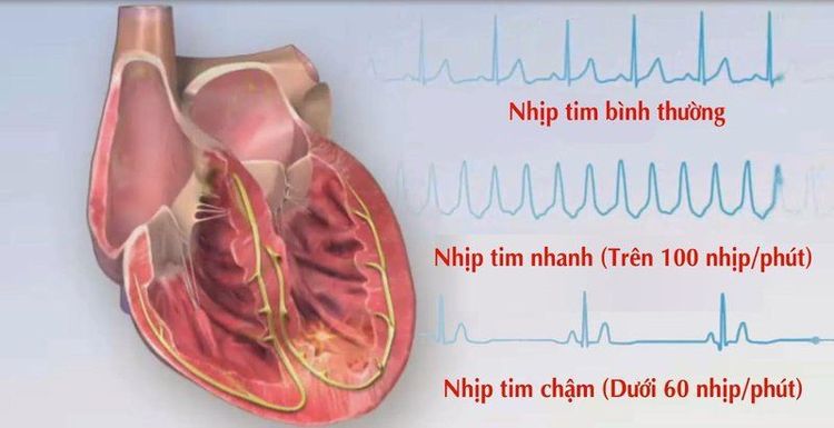 Rối loạn nhịp tim có thể xảy ra do rối loạn huyết động