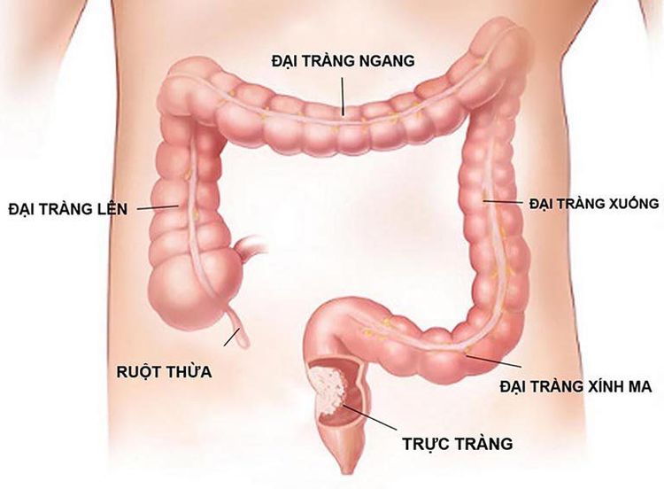 
Quy trình chụp cộng hưởng từ nội soi ảo khung đại tràng
