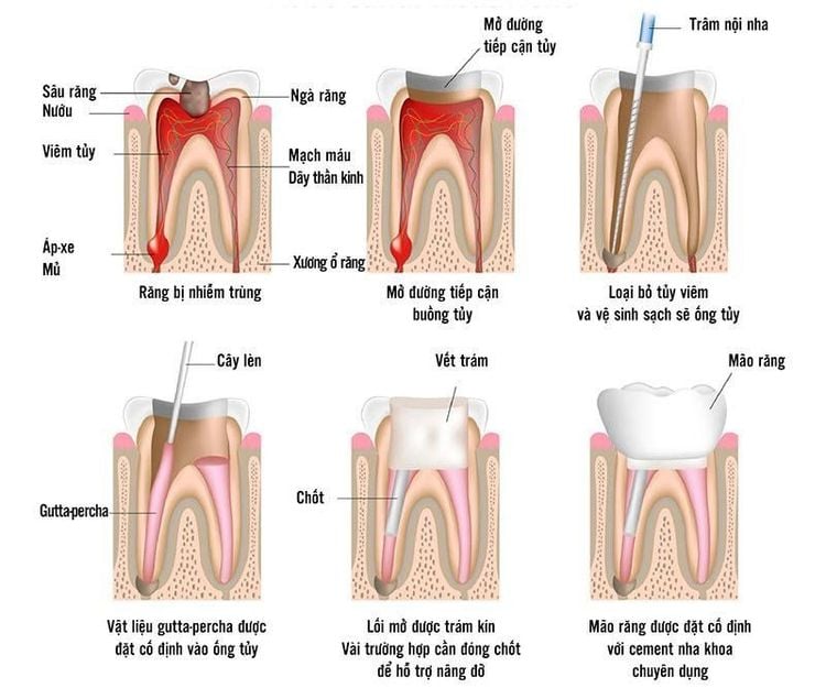 
Quy trình điều trị tủy răng
