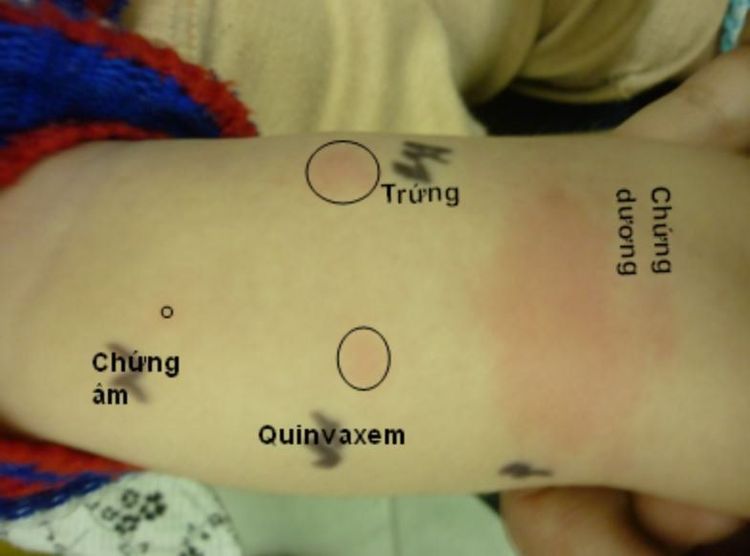 
Test lẩy da dương tính với vắc-xin Quinvaxem (DTPw, hepatitis B & Hib) và lòng trắng trứng
