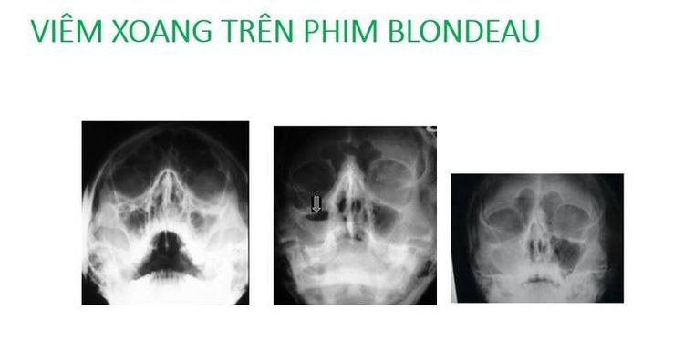 
Hình ảnh viêm xoang trên phim Blondeau
