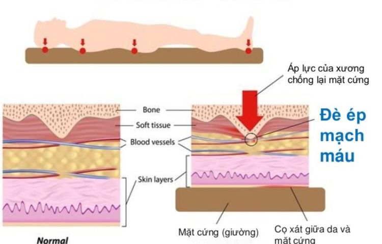 
Cơ chế gây loét do tì đè lâu ngày
