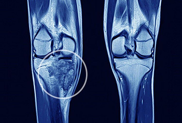 
Hình ảnh bệnh sarcoma xương
