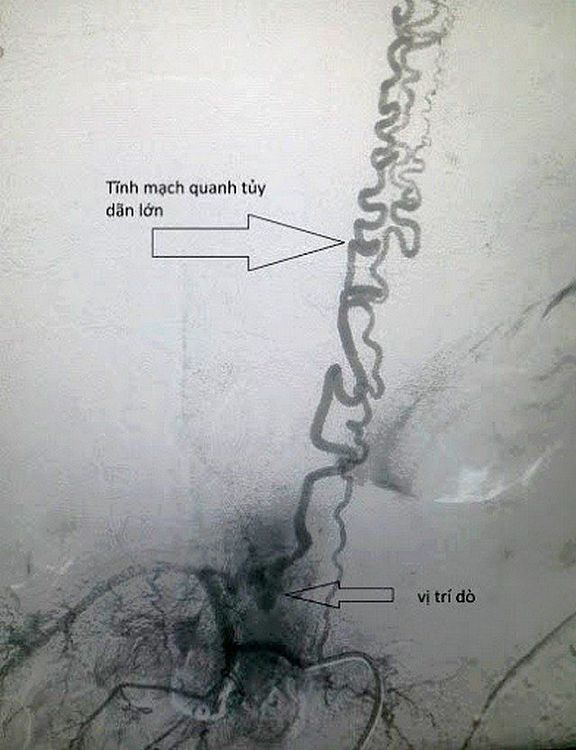 
Hình ảnh dị dạng mạch máu tủy sống
