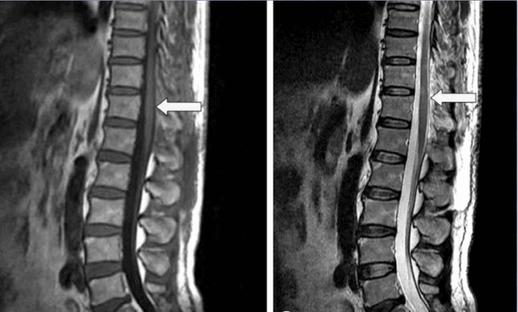 
Ảnh MRI T1 + T2 khối máu tụ ngoài màng cứng
