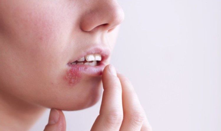 
Bệnh Herpes simplex gây lở loét xung quanh miệng, môi
