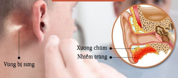 
Trường hợp viêm xương chũm cấp tính cần được phẫu thuật mở khoét chũm đơn thuần
