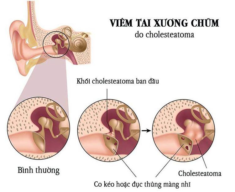 
Hình ảnh mô tả trường hợp viêm tai xương chũm cholesteatoma
