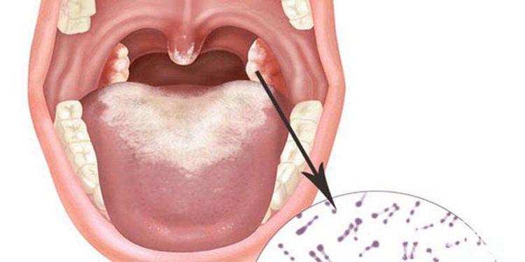 
Bệnh bạch hầu gây hoại tử mô tại nơi vi khuẩn phát triển
