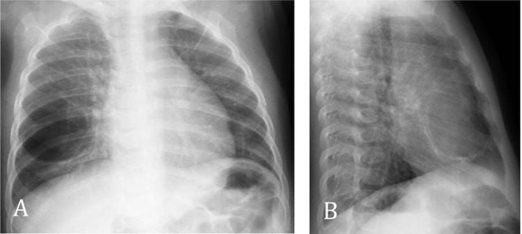 
CPAM type 1 tổn thương dạng nang lớn, rõ nét, chứa đầy khí với sự chèn ép nhu mô lân cận ở thùy giữa bên phải cũng như dịch trung thất sang bên cạnh.
