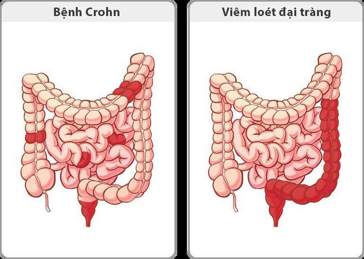 
Hình 2: Hai thể bệnh của bệnh viêm ruột: Bệnh Crohn (viêm ruột từng vùng) và bệnh viêm loét đại tràng
