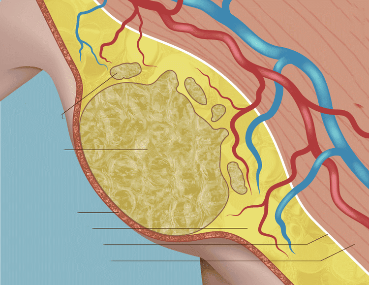 
Dị dạng bạch huyết (LM-Lymphatic Malformations)
