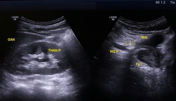 
Hình ảnh siêu âm đường tiết niệu trong chẩn đoán bệnh sỏi thận
