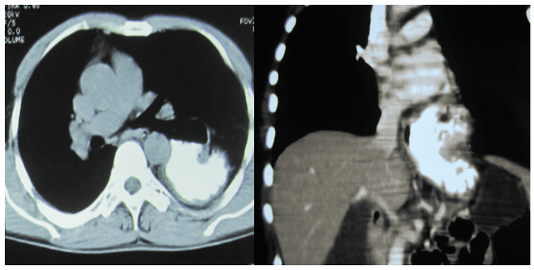 
Hình 15: Hình ảnh CT scan thoát vị khe hoành loại II
