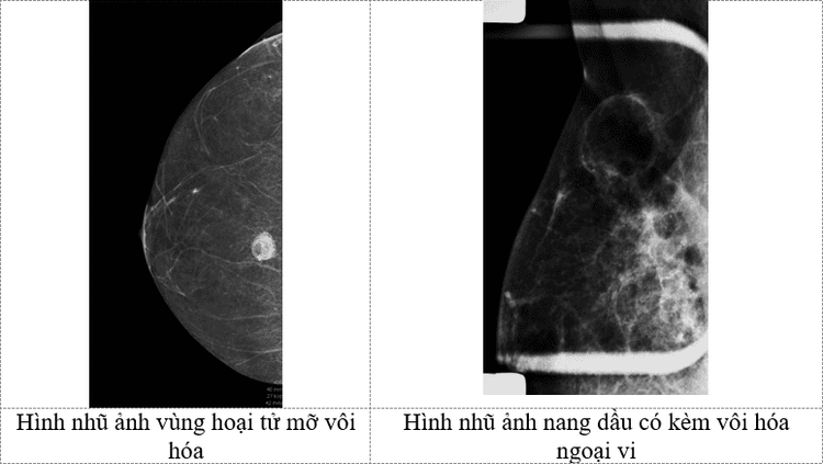 Hoại tử mỡ mô vú: Một số đặc điểm hình ảnh