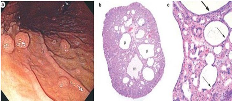 
Polyp tuyến đáy vị là loại polyp biểu mô dạ dày thường gặp nhất
